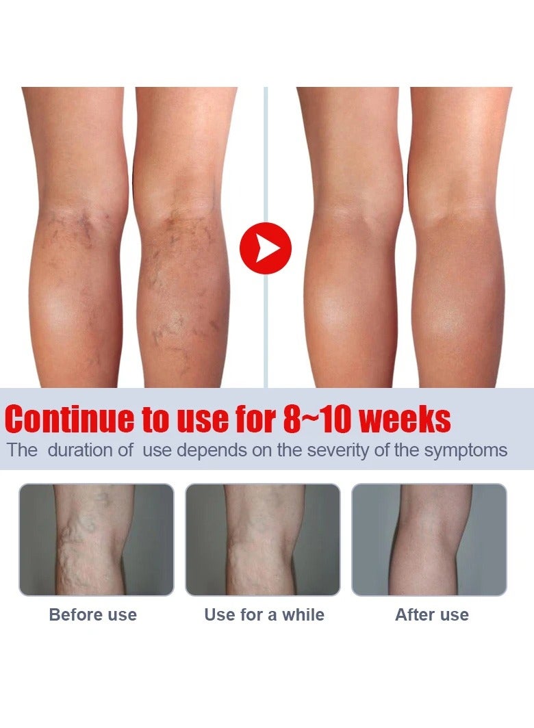 KanyeHB Varicose Veins Remove Cream, Blood Circulation Vein Care Leg Cream, Vasculitis Phlebitis Foot Care Ointment, Pain Relief Therapy Firming Vein Lotion For Treatment Of Varicose Veins - Image 5