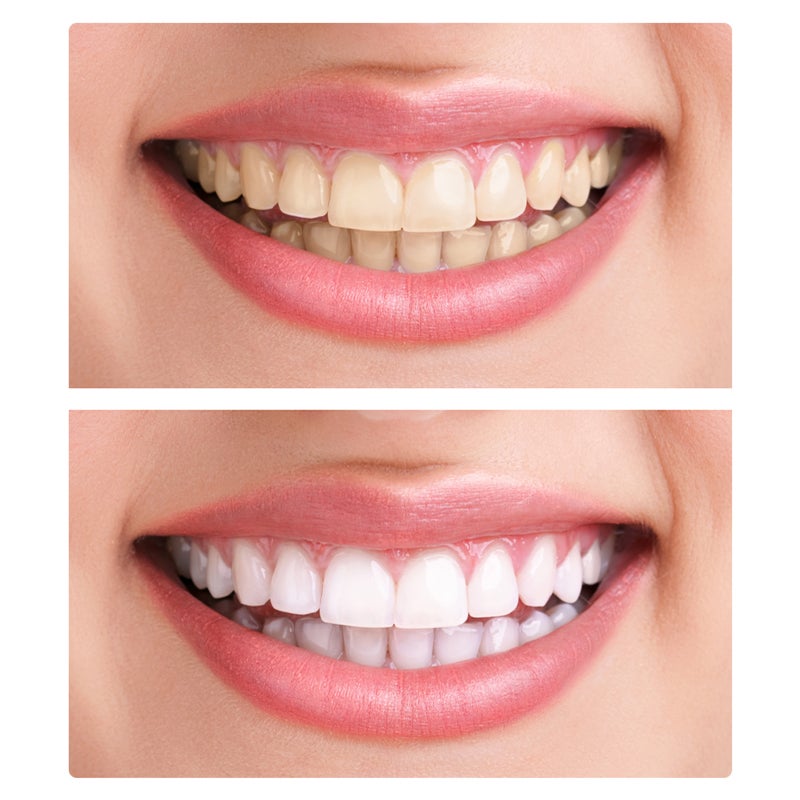 Fake Teeth, 2 PCS Dentures Teeth for Upper and Lower Jaw, Nature and Comfortable, Your Teeth and Regain Confident Smile - Image 3