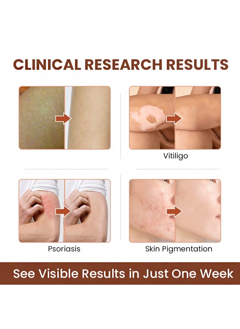 2 Pieces Vitiligo Care Cream，Vitiligo Treatment, Improve Skin Pigmentation, Reduce White Spots