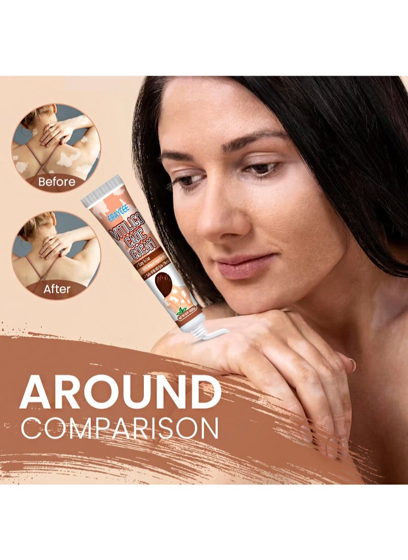 2 Pieces Vitiligo Care Cream，Vitiligo Treatment, Improve Skin Pigmentation, Reduce White Spots