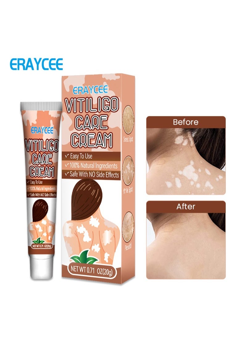 2 Pieces Vitiligo Care Cream，Vitiligo Treatment, Improve Skin Pigmentation, Reduce White Spots