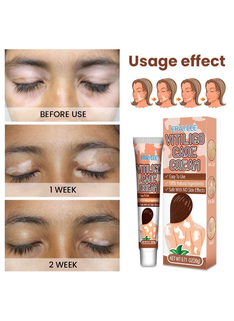 2 Pieces Vitiligo Care Cream，Vitiligo Treatment, Improve Skin Pigmentation, Reduce White Spots