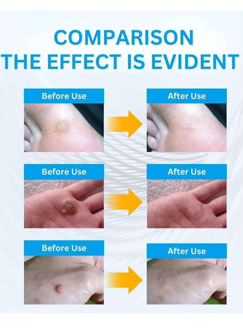 HEALMUSZ Wart Remover Ointment Herbal Ingredients Safe Body Warts Treatment for Acne Moles Scar Wart Treatment Wart Remover for Face Body Wart Remover Gel Cream - Image 2
