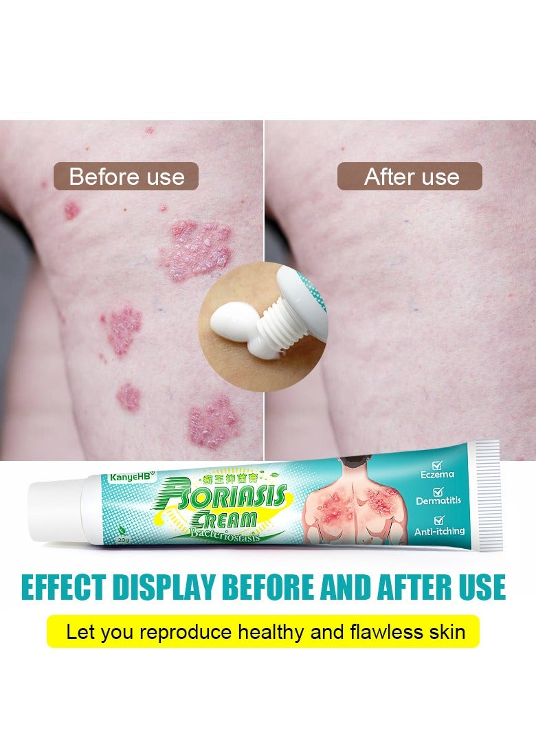 كاني إتش بي Eczema Cream, Maximum Strength Ointment for Rashes, Psoriasis, Dermatitis, Hives, Ringworm, Jock itch, Fungal Infections, Anti-itch, Relief- 20g - Image 3