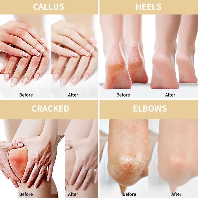 Grocerism Urea Cream 50 Percent for Feet Maximum Strength 5.29 oz with Oat and 2% Salicylic Acid, Foot & Hand Cream included Hyaluronic Acid, Tea Tree and Aloe Vera for Deep Moisturizing, Callus Removing - Image 5