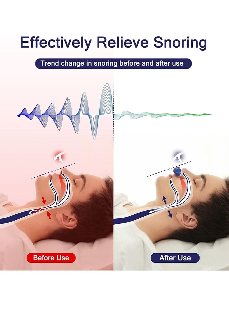 Sharpdo - Anti Snoring Device, Adjustable Wind Speed Snoring Solution, Stop Snoring Suitable for Men and Women - Image 1