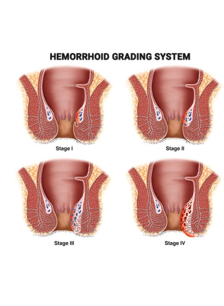 ERAYCEE Hemorrhoid Ointment Hemorrhoid Treatment Hemorrhoid and Fissure Ointment Fast Relief Hemorrhoid Cream Healing Formula Fast Acting Treatment Hemorrhoid Symptom Ointment 20g  - Image 3