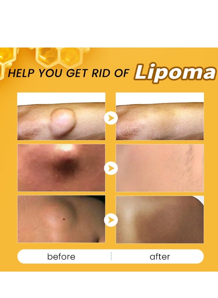 سوميفون كريم إزالة الورم الشحمي من سم النحل 20 جرام، مرهم كريم إزالة الورم الشحمي، كريم القضاء على الورم الشحمي، تخلص من كتل الورم الشحمي الدهنية - Image 2