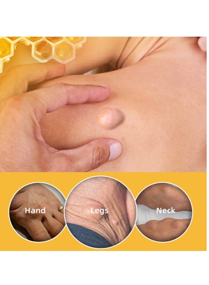 سوميفون كريم إزالة الورم الشحمي من سم النحل 20 جرام، مرهم كريم إزالة الورم الشحمي، كريم القضاء على الورم الشحمي، تخلص من كتل الورم الشحمي الدهنية - Image 4