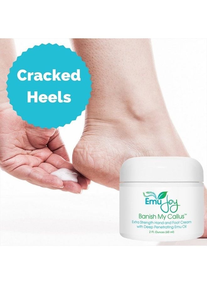Emu Joy - Banish My Callus Foot Callus Cream Hand Callus Remover – For Softening Rough Hard Dry Skin on Feet Hands Knees Elbows - Image 1