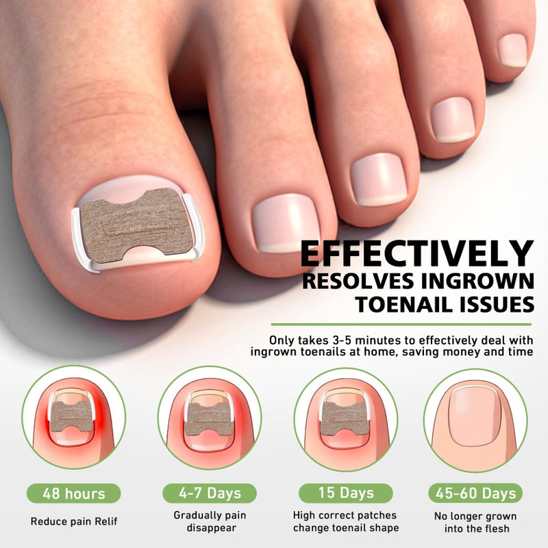 BALUCA 2025 Upgraded Ingrown Toenail Corrector Kit | Professional Ingrown Toenail Treatment & Pain Relief | Home Pedicure Tool Set with Breathable Corrector Strips & Toenail Tools - Image 2