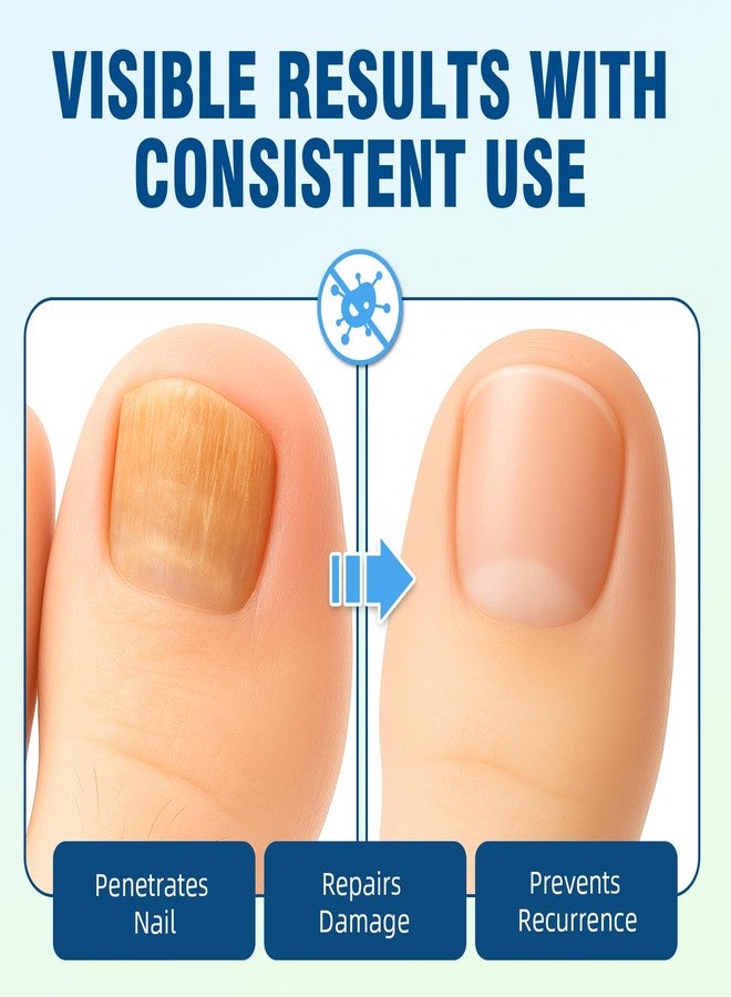 Nexkayee Extra Strength Toenail Fungus Treatment - Nail Repair Solution to Restore Damaged, Discolored, and Brittle Nails with Fast-Acting Natural Formula for Healthy Growth, 30ml - Image 3