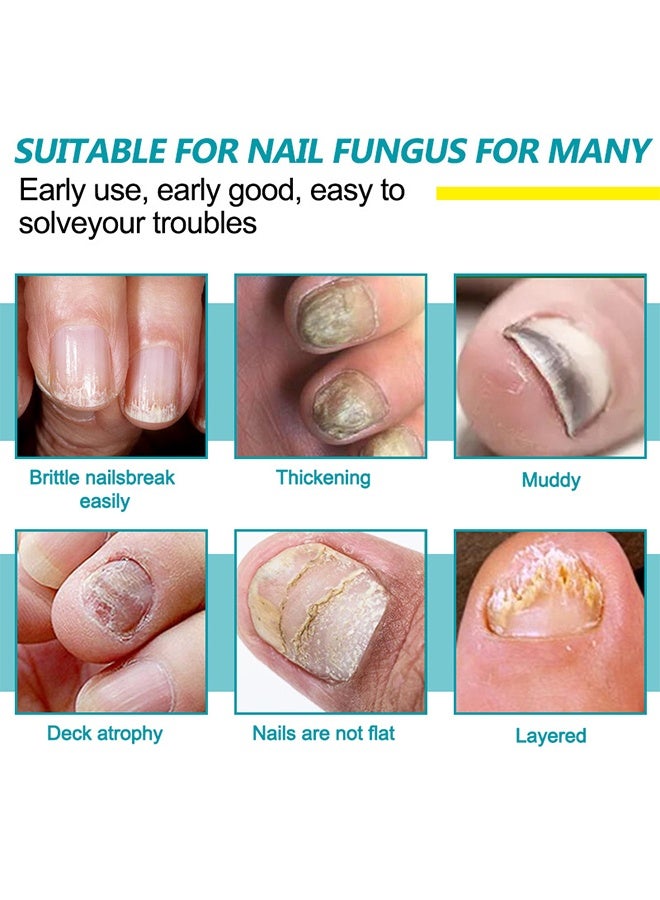 HBESTY Nail Care Pen, Fungal Treatment Solution, Anti Fungal Nail Repair Pen, Nail Fungus Nursing Liquid, Daily Hands And Feet, Nail Care, Nail Lotion, Thickening Soft Nails, Fungal Nail Repair Pen For Nail Damage - Image 5