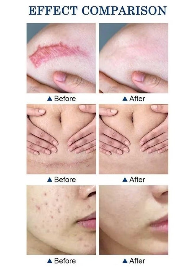 MOOYAM Scar Removal Cream, Skin Repairing Cream Fade Scars/Stretch Marks/Acne Treatment, Improve Scar Skin, Deeply Moisturizes Skin  - Image 4