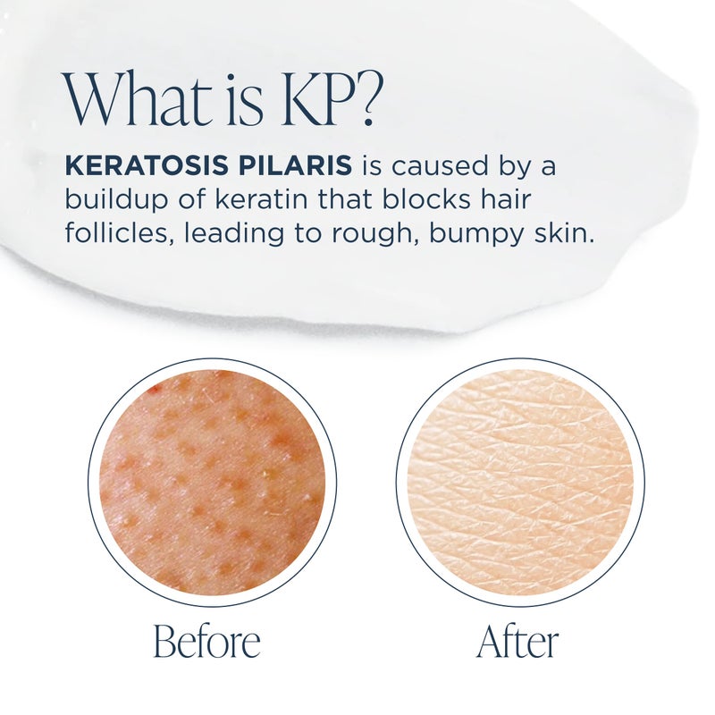 Glytone KP Kit for Keratosis Pilaris - Exfoliating Body Wash, Lotion, Shower Pouf - Smooth Rough & Bumpy Chicken Skin - Fragrance-Free, Routine Kit - Image 3