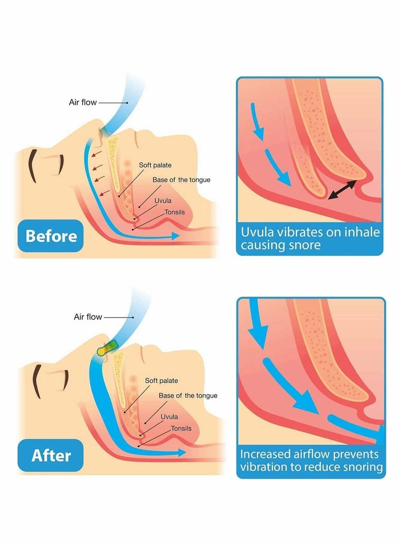 Excefore 4 قطع أجهزة مضادة للشخير مشبك أنف سيليكوني لتخفيف الشخير - Image 2