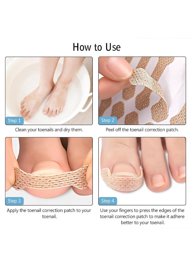 Ingrown Toenail Treatment, 100 Pcs Breathable Ingrown Toenail Strips,Painless Ingrown Toenail Tool, Professional Pedicure for Toenail Corrector Patch - Image 5