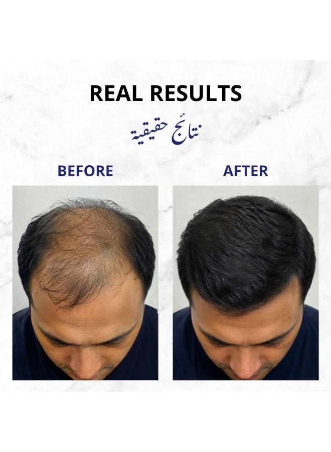 Derresthetic Anapro Hair Fall Serum Spray 50 ml – Hair Regrowth & Hair Loss Treatment - Image 5