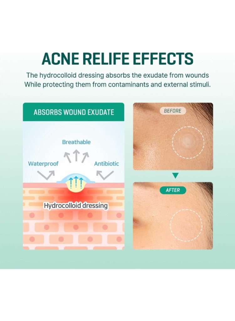 Some by Mi Acne & Blemish Emergency Care – 30 Days Miracle Clear Spot Patch for Fast Healing, Protection & Breakout Control 18grams - Image 5