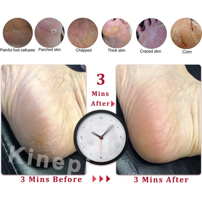 Kinepi Callus Remover Foot Scrubber Colossal Foot File Foot Care and Foot Exfoliator Foot Rasp Pedicure Tools Pumice Stone for Feet,Remove Corn Hard Skin Dead Skin for Use in Shower Foot Scraper Kit - Image 4