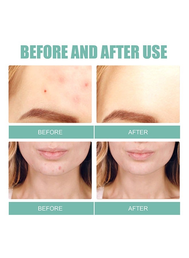 EELHOE Pimple Patches Acne Patches, 5 Sizes 132 Patches Pimple Patches For Face, Chin Or Body, Acne Treatment with Tea Tree And Salicylic Acid, Hydrocolloid Bandages For Acne Skin - Image 4