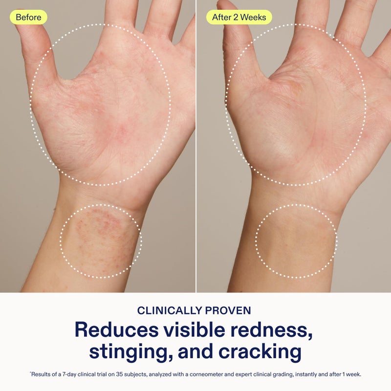 Skinfix Hand Relief Cream - 3 fl oz - Reduces Visible Redness, Stinging & Cracking for Dry, Sensitive Skin - Accepted by the National Eczema Association - Fragrance Free - Vegan, Cruelty Free - Image 3