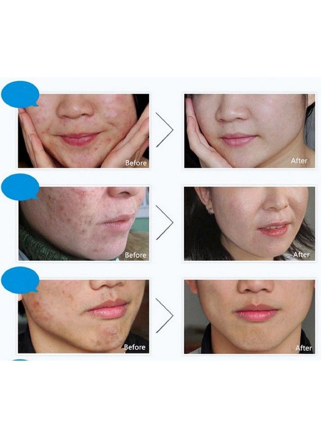 BIOAQUA مجموعة 3 في 1 لمكافحة حب الشباب وإزالة الندبات والبقع والبثور وكريم الزيت والرغوة والندبات وعلامات العيوب وزيت الترطيب 100 جرام + 30 جرام + 30 مل - Image 3