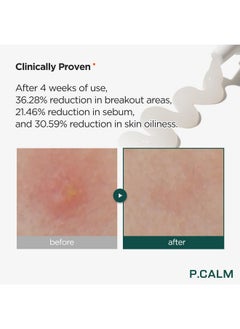 P.CALM Centella Trouble Spot 0.5 Fl.Oz Vegan Breakout Relief Cream For Sensitive Skin Korean Skin Care  - Image 3