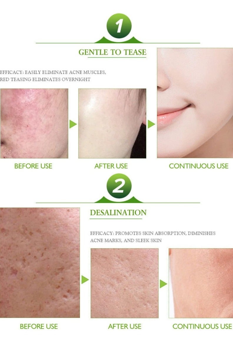 Aichun beauty Kind to Skin Soothing Acne Cream Face Acne Cleaning Cream Skin Care Remove Repair Comedone Pimple Acne Face Acne Cream Oil Control and Skin Calming Formula for Clear Smooth Skin Anti Pimple Treatment Cream 30ml - Image 5