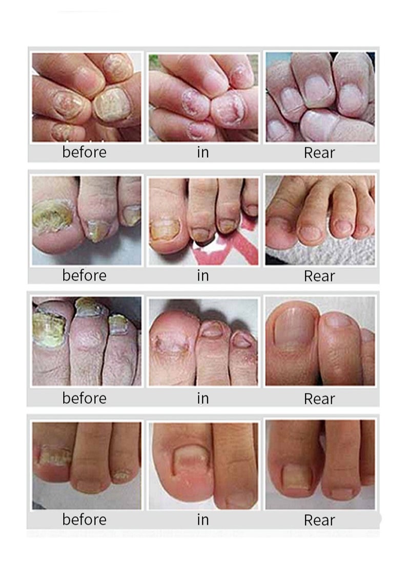 HEALMUSZ - Toenail Fungus Treatment Extra Strength-Fungal Nail Treatment for Toe Nail and Fingernails-Tea Tree Oil Nail Repair Solution for Thick/Broken/Discolored Nails-Renews Damaged Cracked Ingrown Toenail - Image 1