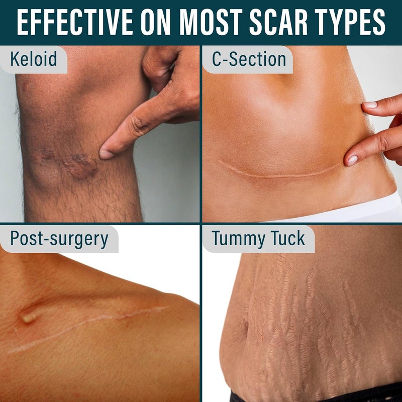Nuvadermis شريط سيليكون نوفاديرميس لعلاج الندبات الجراحية 120 × 15 لفة شريط سيليكون طبي طويل جدًا لندبات جراحة القيصرية وشفط البطن والندبات الجراحية 2 عبوة - Image 4