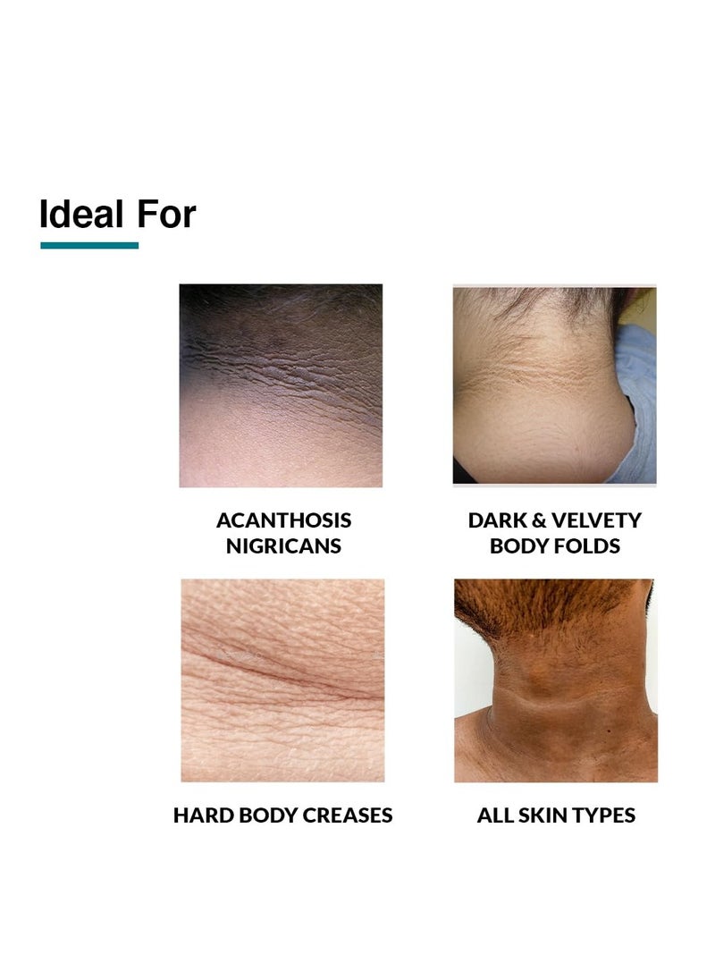 Nigrifix cream for Acanthosis Nigricans | Whitening Cream Lightening Cream Underarm Whitening Cream Effective for Armpit Knees Elbows & Knuckles | Dermatologist Tested - 3.52OZ