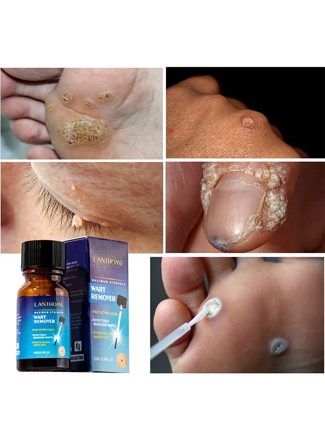 Lanthome Wart Remover, Fast Acting and Painless Skin Tag Remover Liquid, Tags and Mole Remover, Tag-Remover for Hands and Body, Plantar Wart, Common Wart, Corn, Flat Wart - Image 2