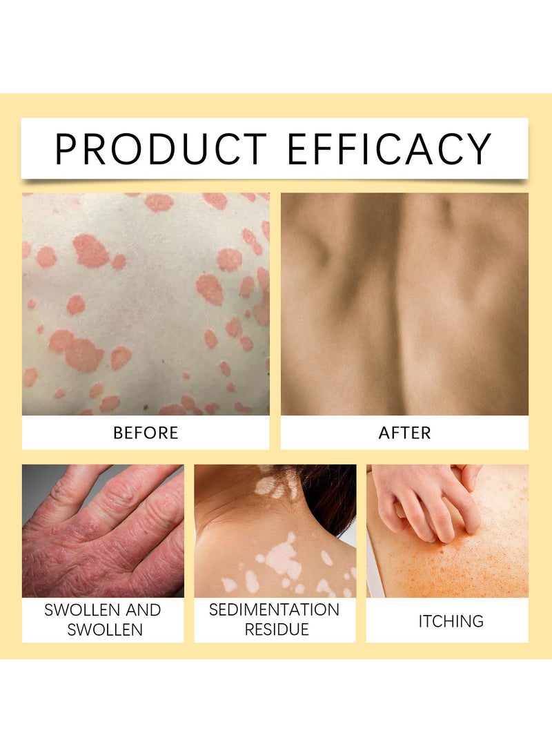 SOUTH MOON Bee Venom Psoriasis Cream Solve Itching Redness And Swelling On The Skin Of Hands And Feet,Moisturize And Care For The Skin  - Image 2