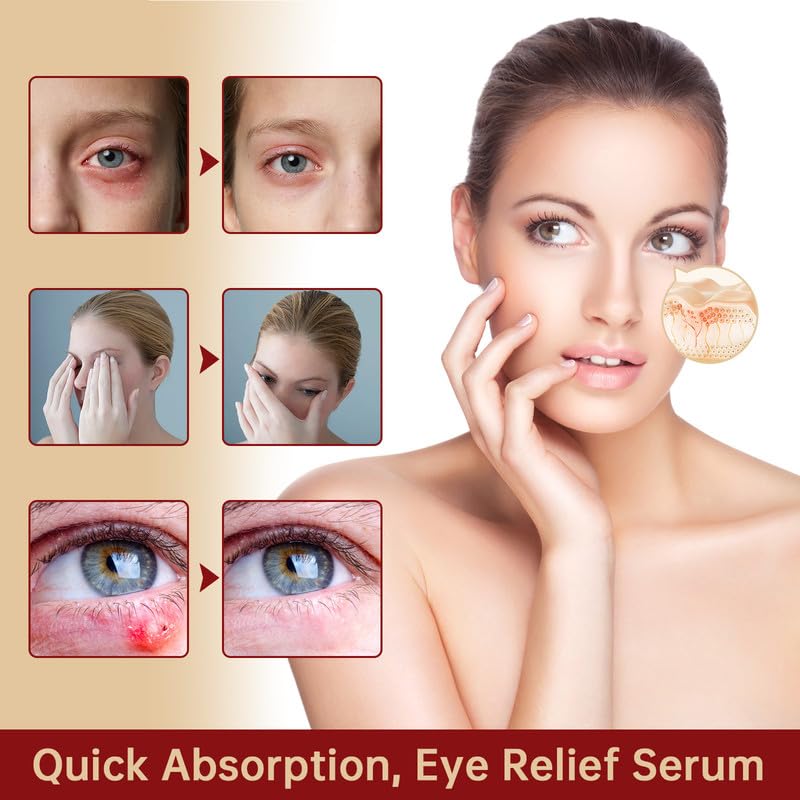 MIZEEYE Chalazion Eye Treatment For Blepharitis 2 PCS Moisturize Eyelids Serum and Chalazion Remover Gentle Under Eye Relief Serum For Dark Circles Eye Bags Puffiness - Image 5