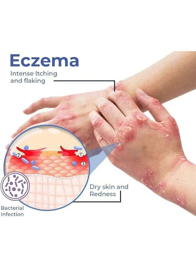 SOUTH MOON - Eczema Therapy Spray 30ml, All Natural Eczema Treatment, Psoriasis Treatment, Fast Relieve Itching and Redness，Skin Care Pain Itch Therapy Spray - Image 1