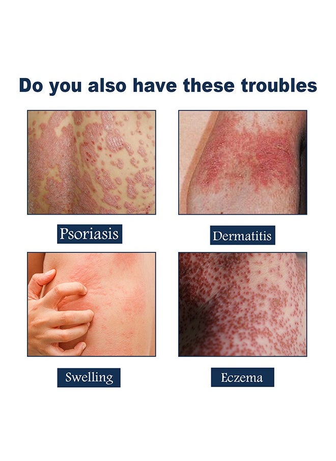 SOUTH MOON - Eczema Therapy Spray 30ml, All Natural Eczema Treatment, Psoriasis Treatment, Fast Relieve Itching and Redness，Skin Care Pain Itch Therapy Spray - Image 1