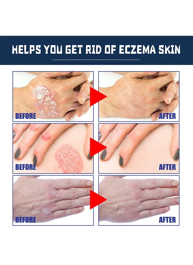 SOUTH MOON - Eczema Therapy Spray 30ml, All Natural Eczema Treatment, Psoriasis Treatment, Fast Relieve Itching and Redness，Skin Care Pain Itch Therapy Spray - Image 1