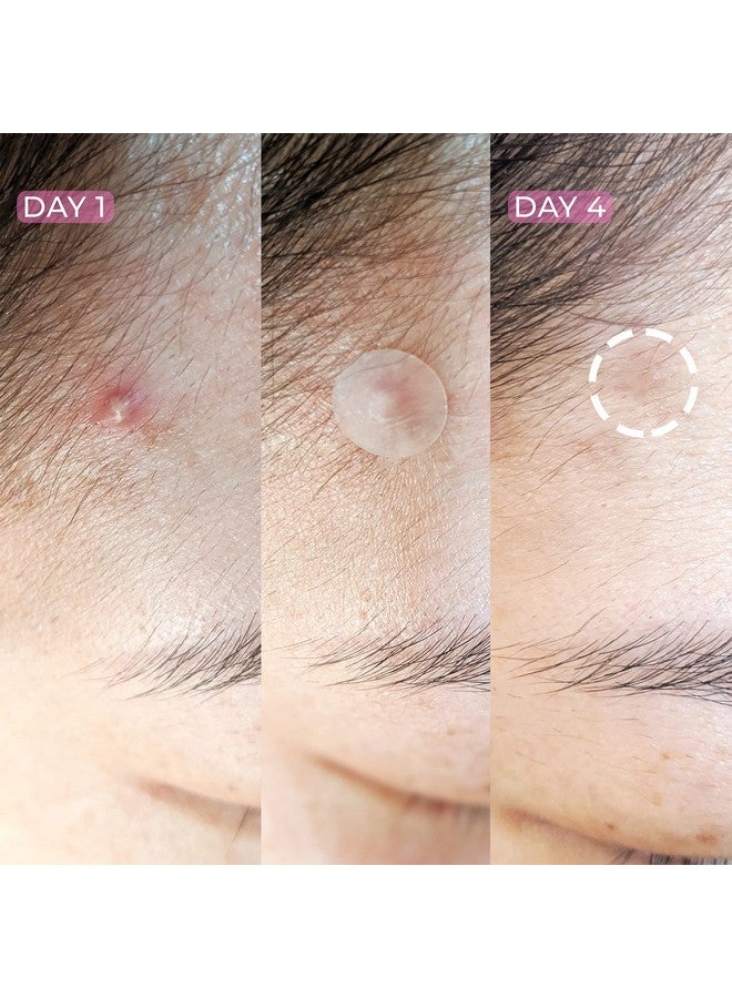 HANHOO Blemish Patch Hydrocolloid Blemish Patches For Surface Blemishes For Face And Body Pimples 12 Packs 36 Patches Per Pack 432 Total Blemish Patches - Image 5