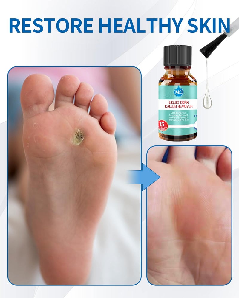 MQ Professional Corn & Callus Remover Liquid for Feet & Toes â€“ Fast Acting for Corn Removal, Hard Skin & Dead Skin â€“ Includes 15ML Solution + 15 Cushions + 10 Swabs â€“ Effective Foot Care Solution - Image 4