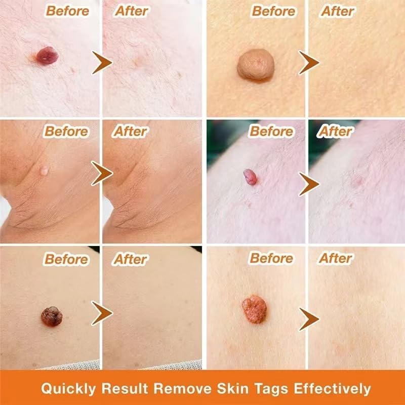 Makbeaty Tag and Wart Remover Natural Plant Formula Portable Skin Care Skin Tag Corrector for Face and Body,Fast-Acting and Effect，2PCS - Image 5