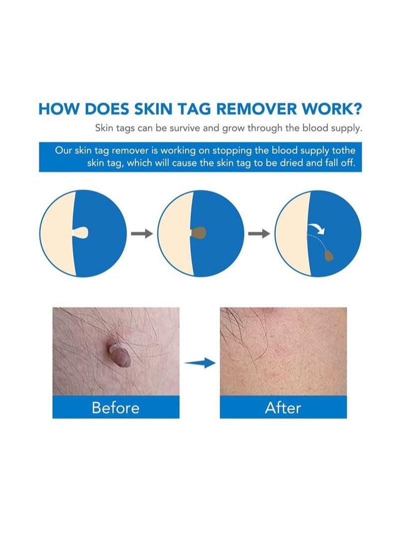 Sefudun - 2 In 1 Design Skin Tag Removal Kit Double Sided Design Safe for All Kind Of Skin Tags For Small to Medium 2mm to 4mm Bands For Medium to Large 5mm to 8mm Bands Unisex - Image 1