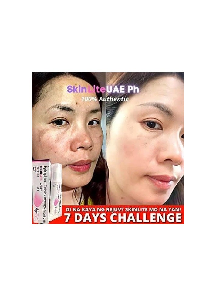 SKINLITE Melasma Whitening Skinlite Cream 20G 3PCS  - Image 4