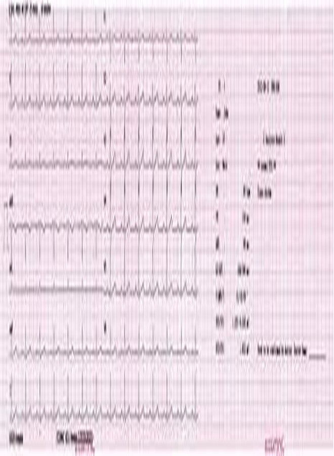 REVALS ورق حراري لتخطيط القلب الكهربائي REVALS ECG BPL 6208 مقاس 80 مم × 20 متر (مجموعة من 6 لفات) - Image 3