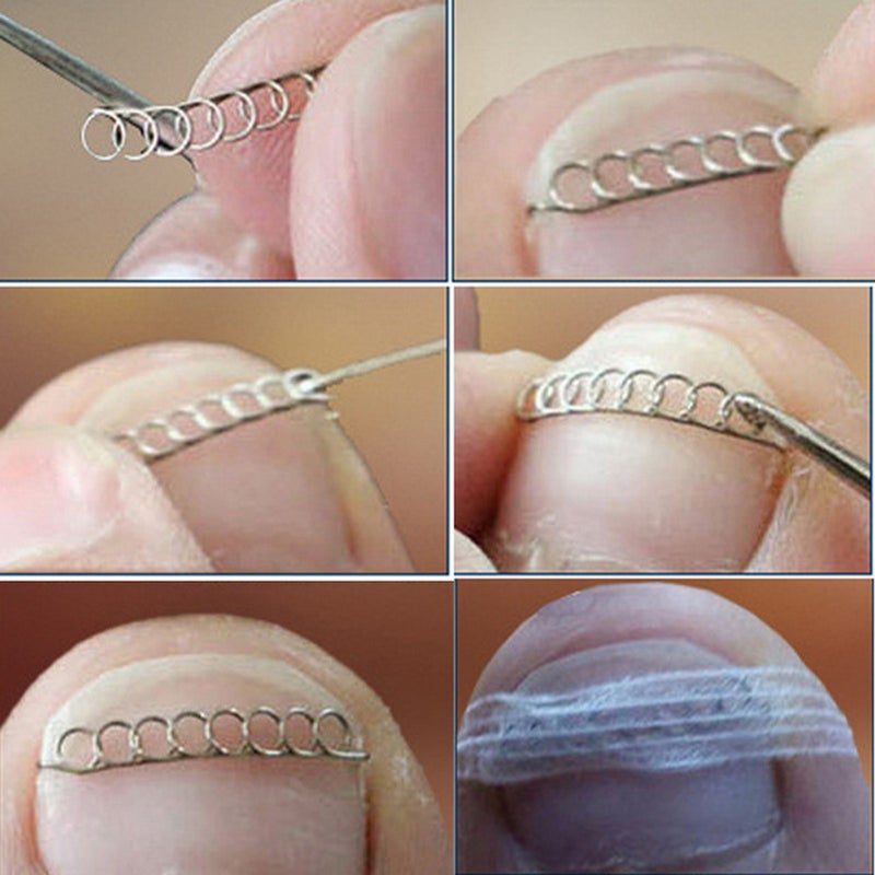 Ingrown Toenail Correction Set Treatment Kit Stainless Steel Ingrown Toenail Correcter Lifter Tweezers Toenail Sticker Spring Strips Toe Protectors Foot Care Tool Kit - Image 4