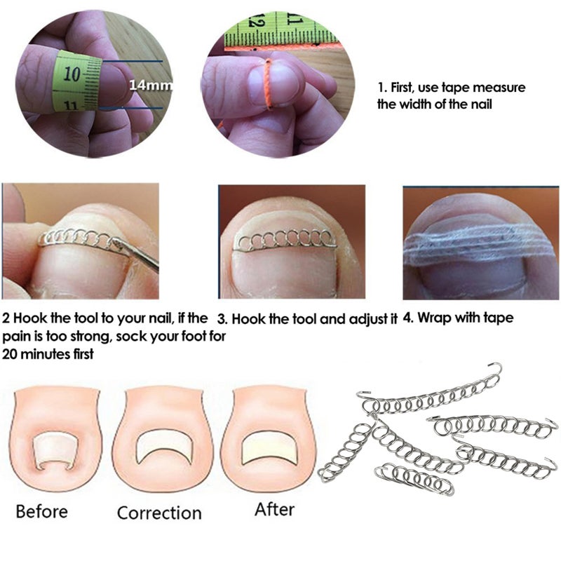 Ingrown Toenail Correction Set Treatment Kit Stainless Steel Ingrown Toenail Correcter Lifter Tweezers Toenail Sticker Spring Strips Toe Protectors Foot Care Tool Kit - Image 5
