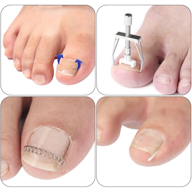 Ingrown Toenail Correction Set Treatment Kit Stainless Steel Ingrown Toenail Correcter Lifter Tweezers Toenail Sticker Spring Strips Toe Protectors Foot Care Tool Kit - Image 2