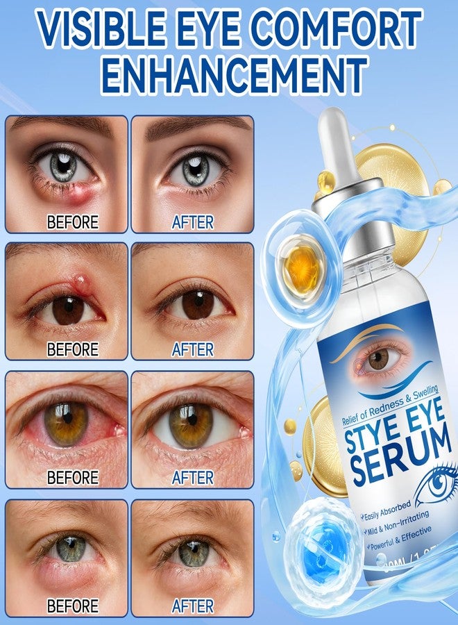 HORSEFISH TOOL Stye Eye Treatment, 30ml Natural Eye Serum, Eye Stye Relief Serum for Eye Styes, Blepharitis, Chalazions and Dry Eyes Treatment, Daily Area Cleansing, Relieves Dryness and Restores Healthier Skin - Image 2