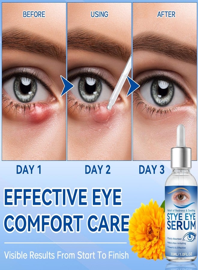 HORSEFISH TOOL Stye Eye Treatment, 30ml Natural Eye Serum, Eye Stye Relief Serum for Eye Styes, Blepharitis, Chalazions and Dry Eyes Treatment, Daily Area Cleansing, Relieves Dryness and Restores Healthier Skin - Image 5