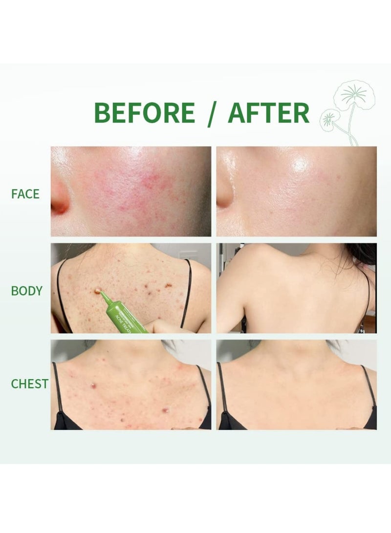 ibcccndc Acne Treatment Balm Herbal Acne Gel Powerful Acne Treatment Reduce the Appearance of Pimples and other Blemishes Leaving Your Skin Looking Clear And Healthy Advanced Acne Scar Spot Treatment Gel 15g - Image 3